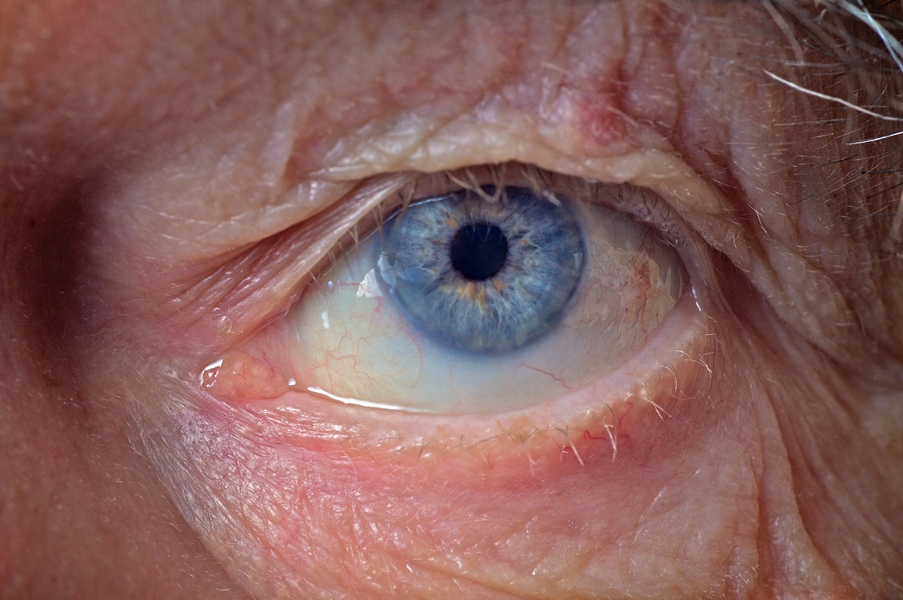 Thumbnail for Flinders researchers find new marker for glaucoma