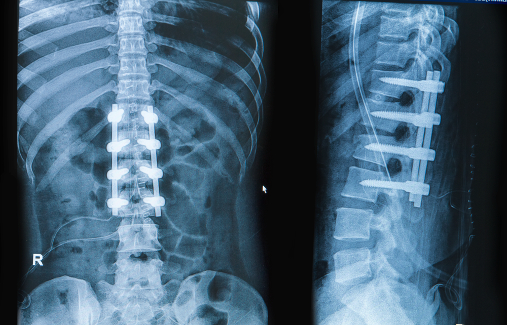 Thumbnail for Spinal procedure no longer such a pain in the back