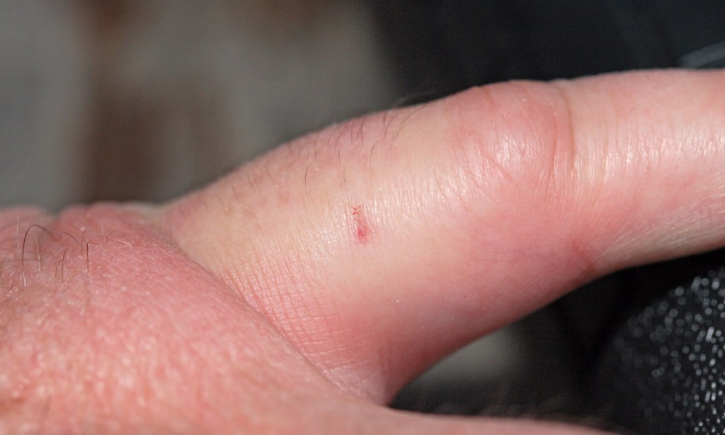 Thumbnail for Bee sting vaccine opens door to new allergy remedies