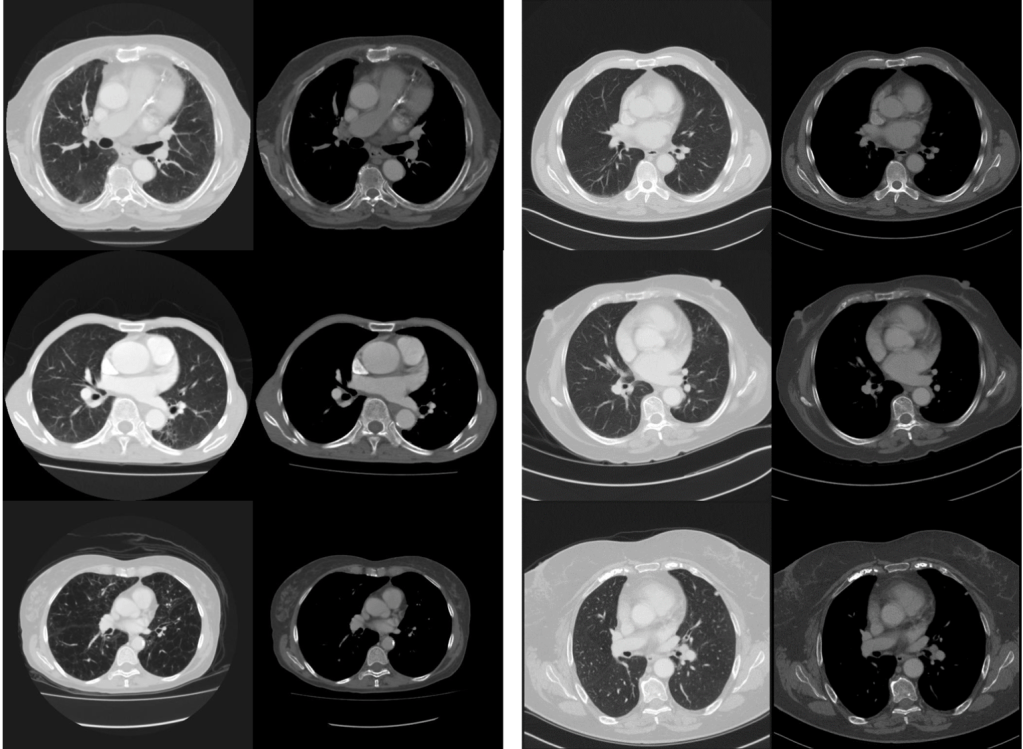 Research images of the coronary artery: the left side shows mortality cases with prominent visual changes of emphysema, cardiomegaly, vascular disease and osteopaenia. The survival cases (right side) appear visually less diseased and frail. Supplied image