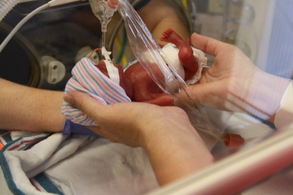 Thumbnail for Prem babies’ survival affected by different factors at 23 vs 25 weeks