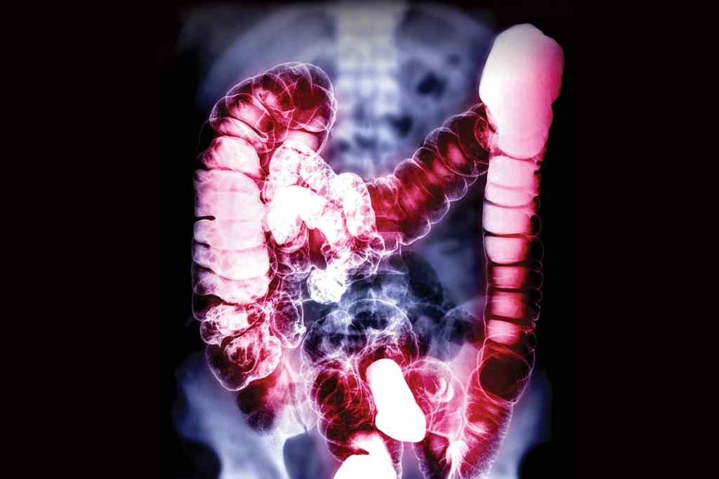 Thumbnail for The discovery that changed how the world treats bowel cancer