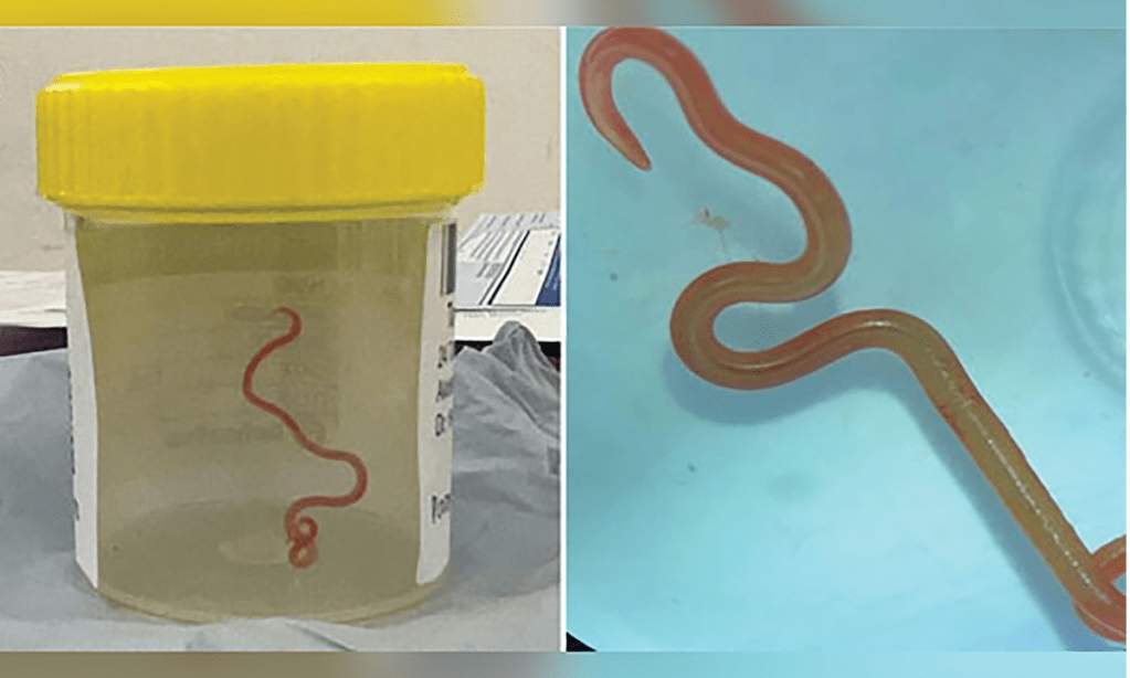 Thumbnail for Snake parasite found in woman’s brain
