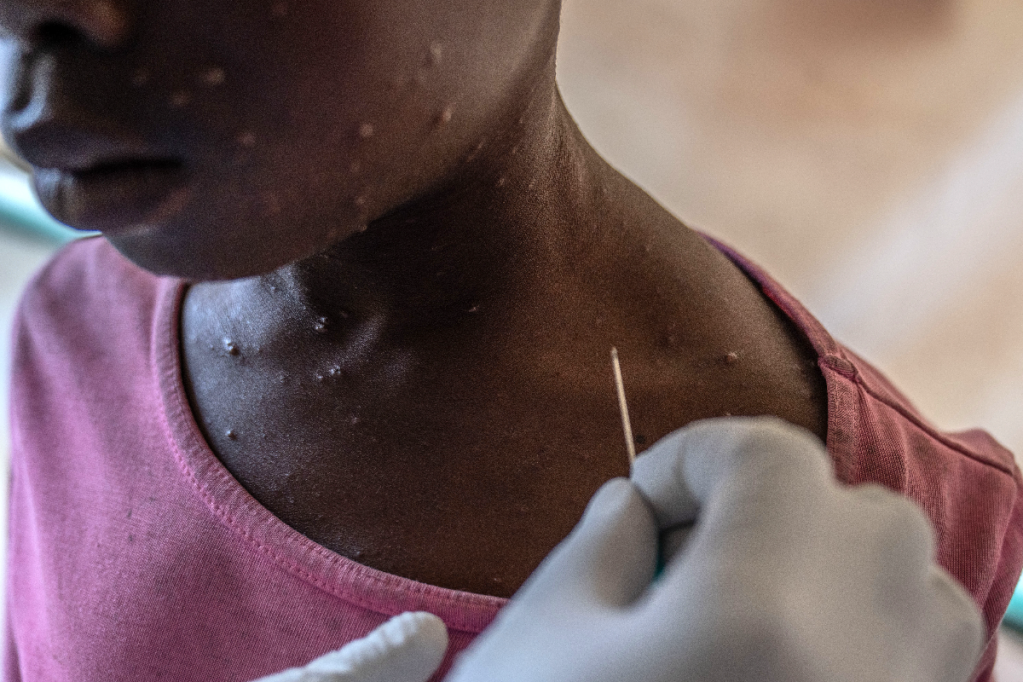 Thumbnail for New mpox virus strain worries scientists